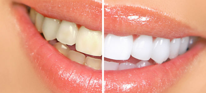 biolase fogfeherites